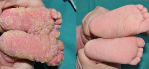 Afectación en los pies de la niña antes y después del tratamiento.